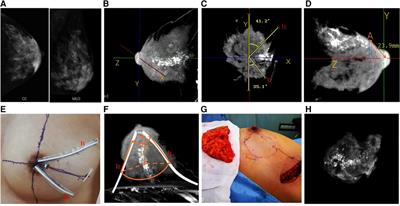 Cone-beam breast CT-guided surface location facilitates breast-conserving surgery in breast cancer patients with extensive calcifications: A pilot study